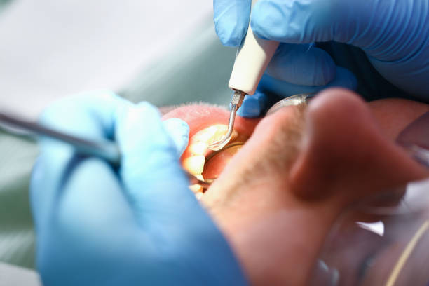 Best Emergency Tooth Extraction in Langley Park, MD