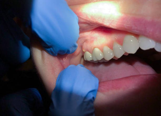 Best Emergency Tooth Extraction in Langley Park, MD