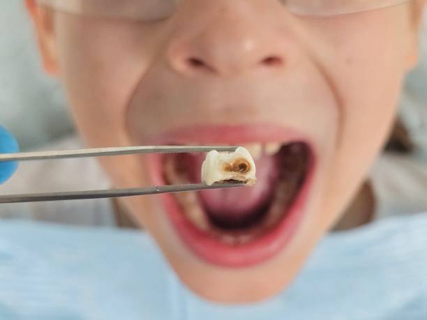Best Emergency Treatment for Toothache in Langley Park, MD